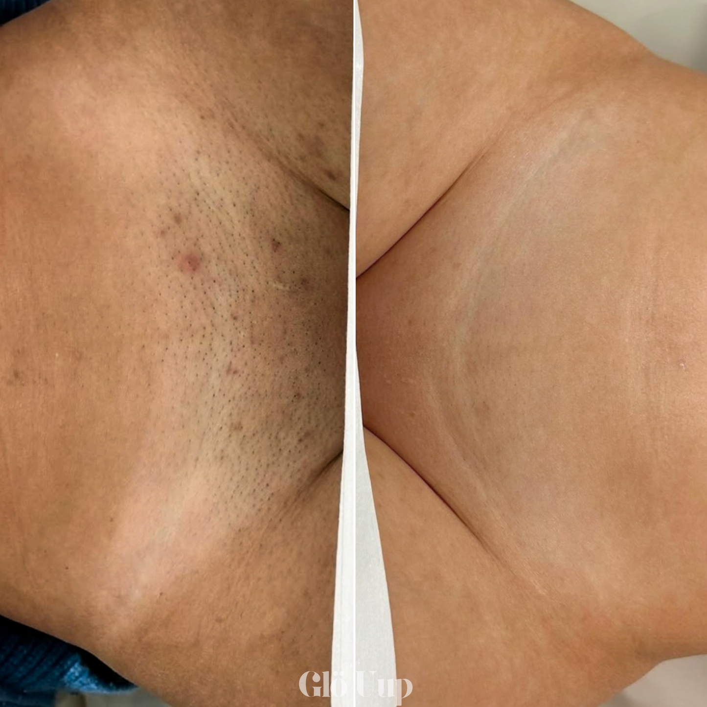GlöUup Razor- Flawless skin in seconds, lasts FOREVER