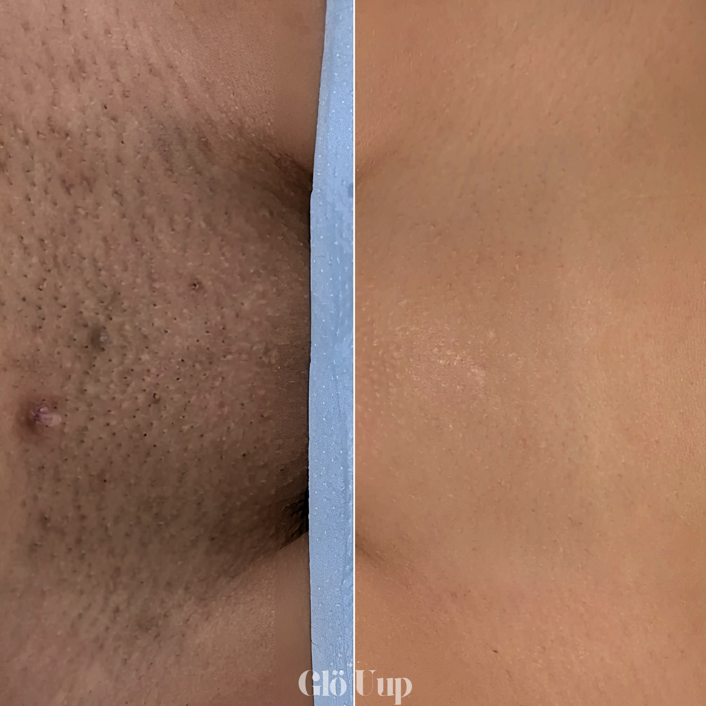 GlöUup Razor- Flawless skin in seconds, lasts FOREVER