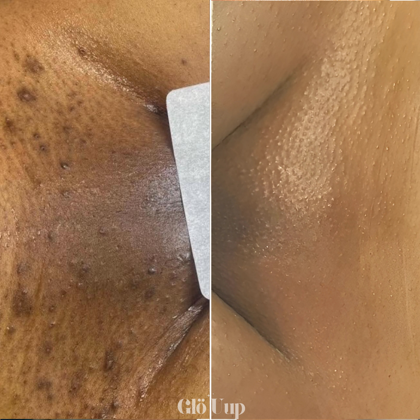 Fett rasieren mit Sheabutter (Paket)