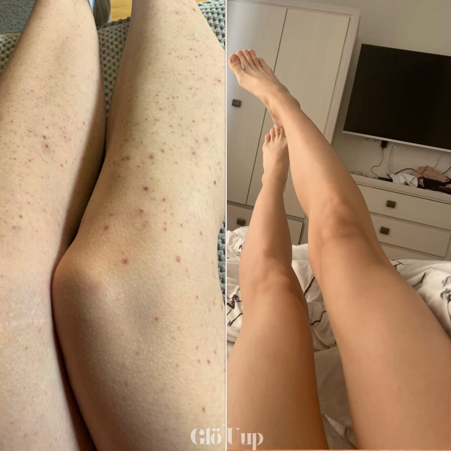 GlöUup Razor- Flawless skin in seconds, lasts FOREVER
