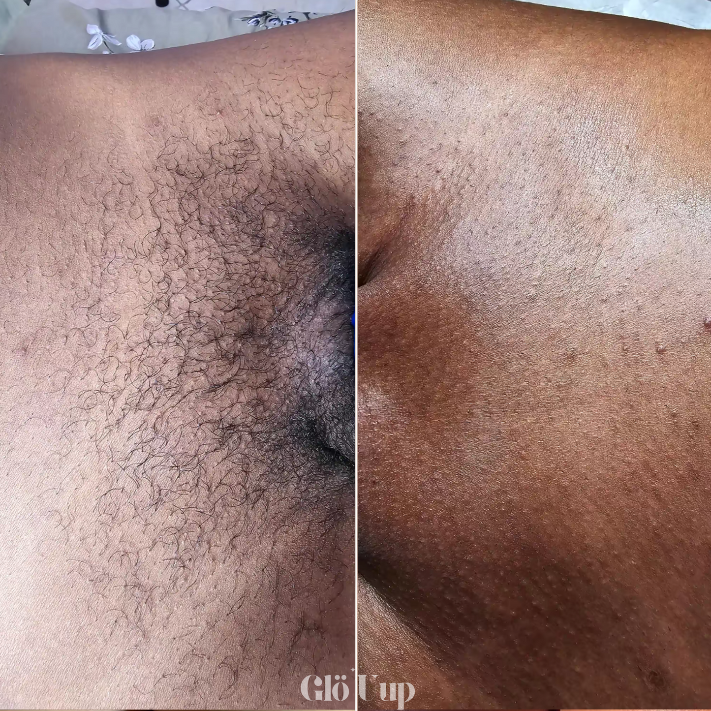 GlöUup Razor- Flawless skin in seconds, lasts FOREVER