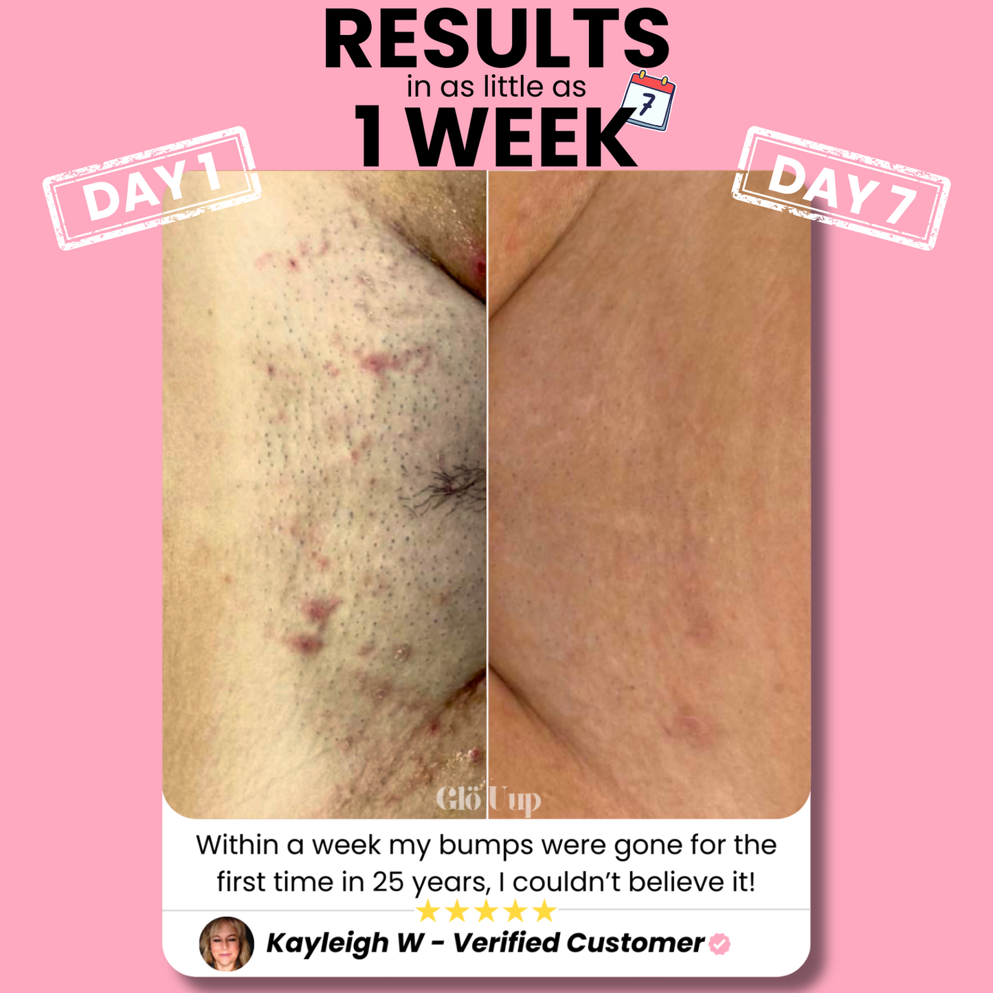 GlöUup Razor- Flawless skin in seconds, lasts FOREVER